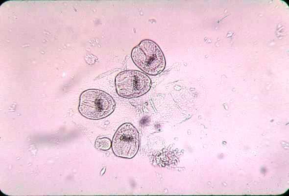 Кристаллы шарко в кале. Эхинококкоз микроскопия. Сколексы эхинококка микроскопия.